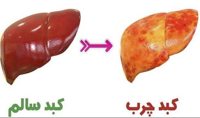 چطور به کبد چرب مبتلا می شویم؟ / 7 نکته موثر در آسیب  به کبد