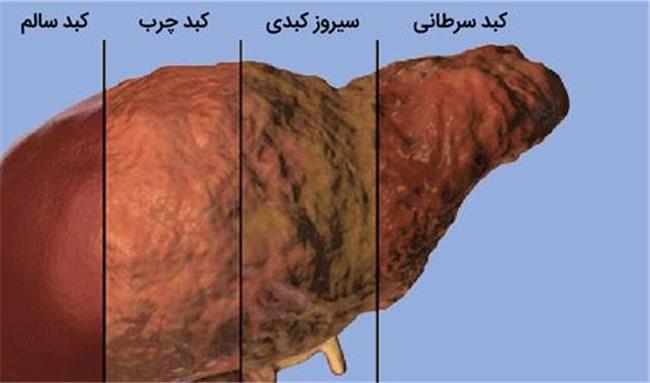 ارتباط خواب با کبد چرب غیر الکلی چیست؟