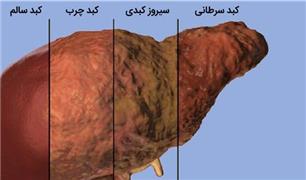 ارتباط خواب با کبد چرب غیر الکلی چیست؟