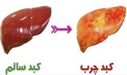 چطور به کبد چرب مبتلا می شویم؟ / 7 نکته موثر در آسیب  به کبد